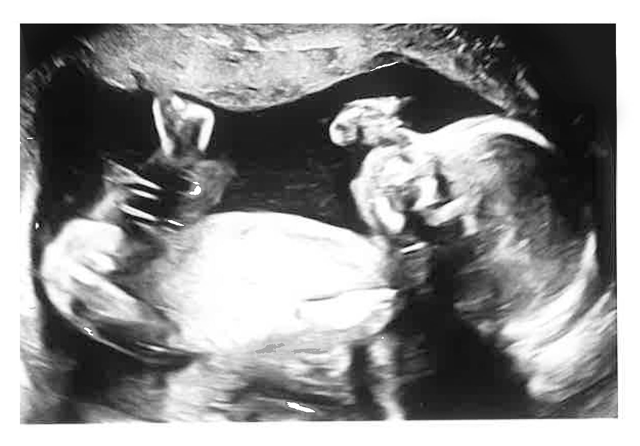 Ultrasound photo of our baby